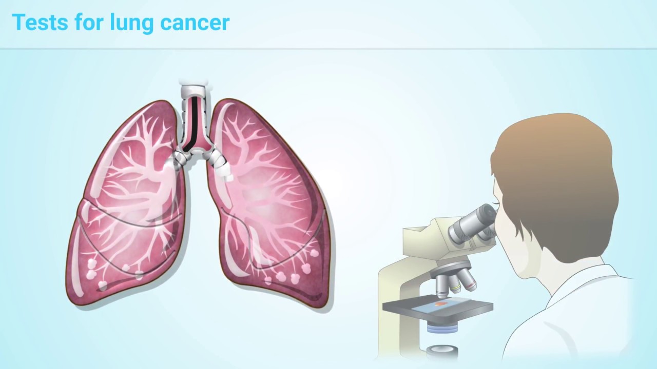 What is Lung Cancer? Breast Cancer Daily